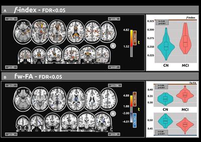 Exploring white matter microstructural alterations in mild cognitive impairment: a multimodal diffusion MRI investigation utilizing diffusion kurtosis and free-water imaging